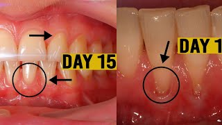 Grow Back Your Receding Gums In Just  2 Week Say Goodbye to Receding Gums