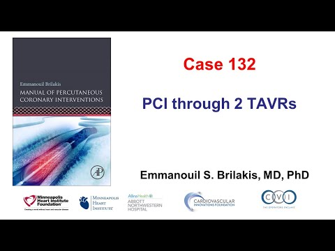 Case 132: Manual of PCI - PCI through 2 TAVRs