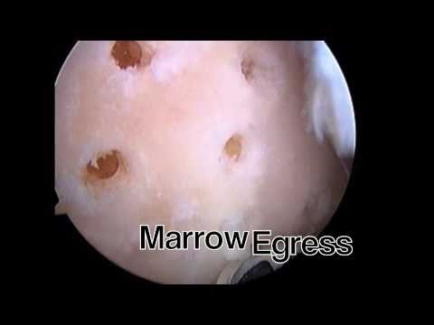 Technika mikrozłamań w uszkodzeniu chrząstki IV stopnia