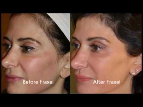 Fraxel Treatment Testimonial
