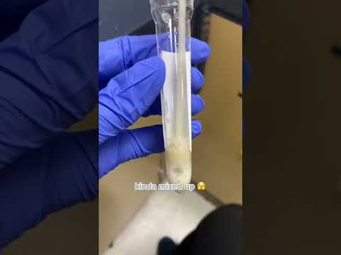 Cloudy Urine Vs Normal Urine Medical test #urine #foamyurine #cloudyurine