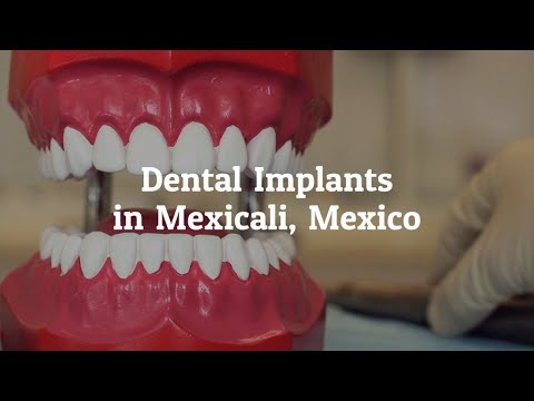 Important Details on Dental Implants in Mexicali, Mexico