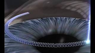 Entendendo o tratamento de anel corneano para ceratocone - Vídeos | Dr. Marcelo Vilar