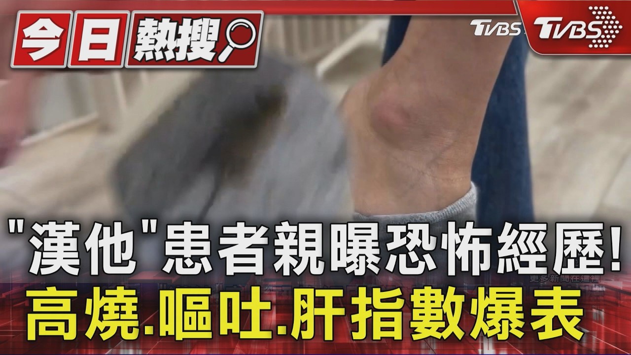 獨家影音／被鼠咬以為沒事！　1月後「燒到40度」　肝指數飆升