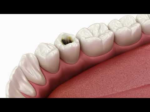 Root Canal Treatment