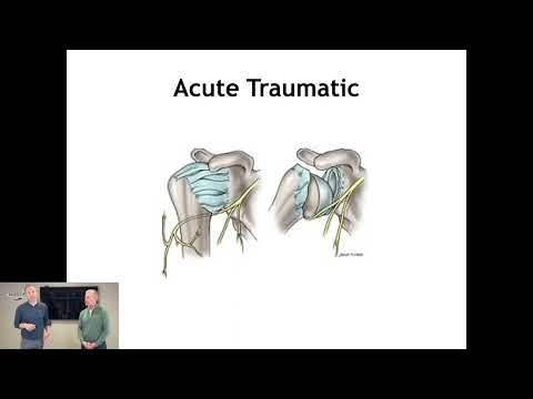 Axillary Neuropathy | ChiroUp