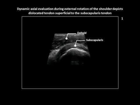 Superficial dislocation (instability) of the long head of biceps brachii tendon on ultrasound