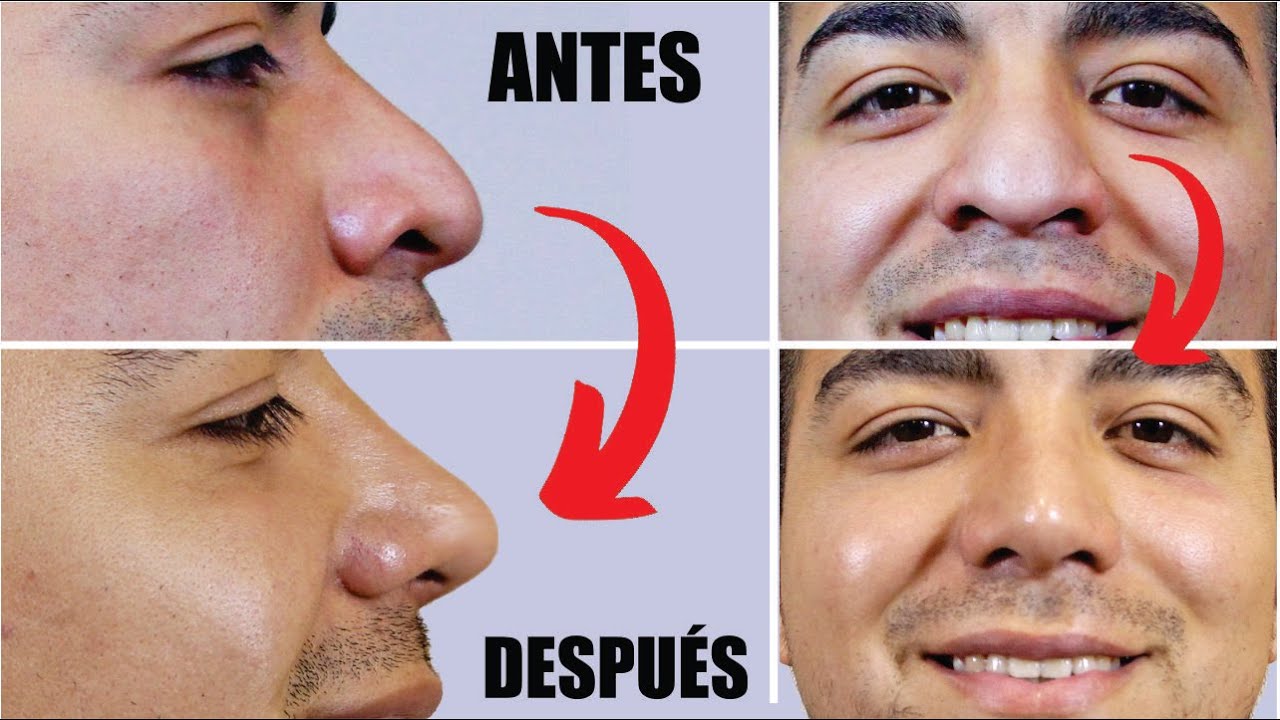 Watch RINOPLASTÍA en HOMBRES 👃🏼 Antes y Después de la rino 👃🏼 Un CAMBIO de INFARTO! 🤩 Dr FREDDY CASTILLO Now RINOPLASTÍA en HOMBRES 👃🏼 Antes y Después de la rino 👃🏼 Un CAMBIO de INFARTO! 🤩 Dr FREDDY CASTILLO