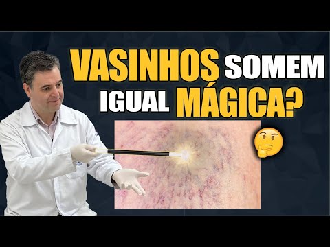 Aplicação nas varizes e vasinhos das pernas. Realmente funciona?
