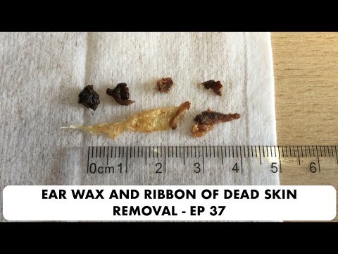 RIBBON OF DEAD SKIN AND EAR WAX REMOVAL - EP 37
