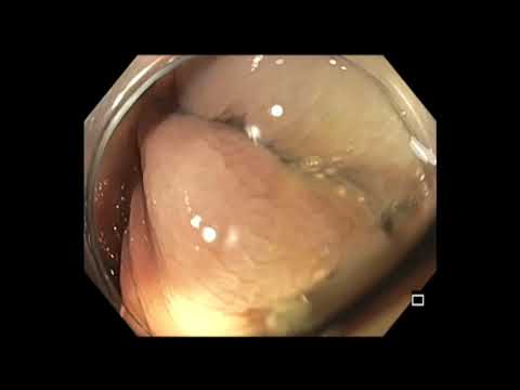 Coloscopie: mucosectomie endoscopique de l'adénome dentelé sessile du caecum attaché à la paroi après une biopsie