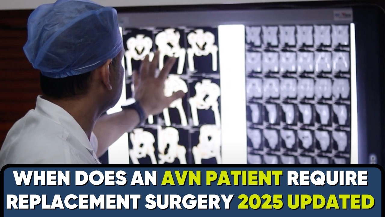 When Is Hip Replacement Needed for AVN Patients? 2025 UPDATED