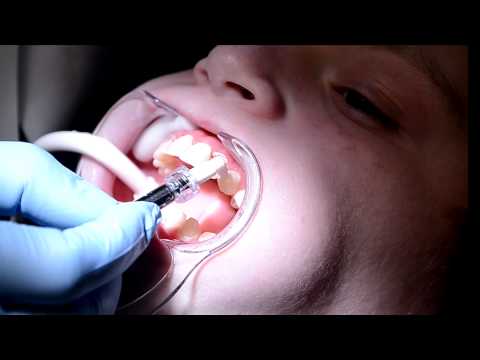 Icon White Spot and Caries Removal by Dr. LynAnn Mastaj. How Does it Work?