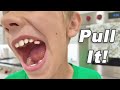 His Tooth FELL OUT!!