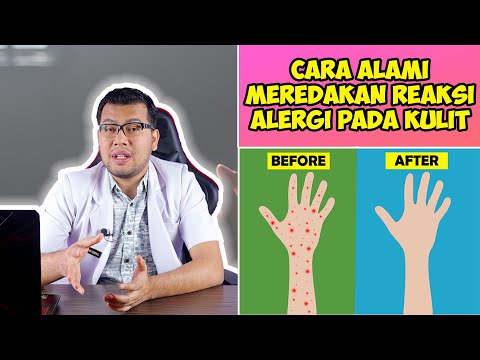 CARA ALAMI MEREDAKAN REAKSI ALERGI PADA KULIT - DOKTER SADDAM ISMAIL