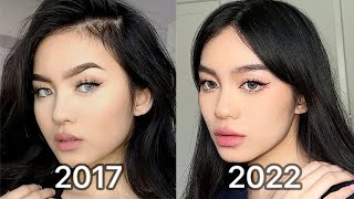 How I Changed My Face (lip injections & botox after 5 years...)