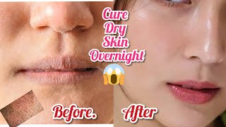 How to cure,heal,treat , broken, cracked skin on face |fast| dry skin cure overnight |treatment |dry