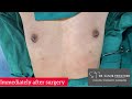 Gynecomastia Surgery In Nepal Gynecomastia Drsanjibtripathee Maleboobs