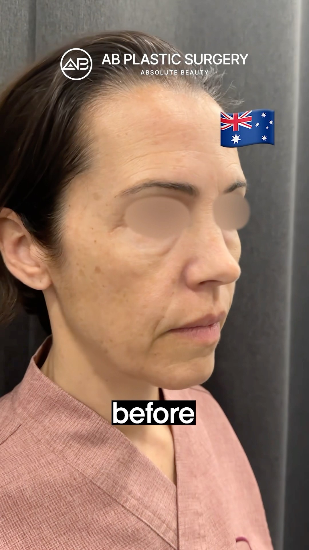 Facelift Transformation: She Looks 20 Years Younger!