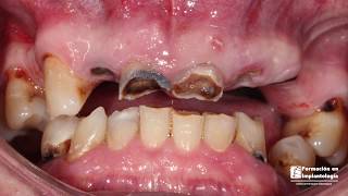 Implantes dentales Caso completo Dientes inmediatos