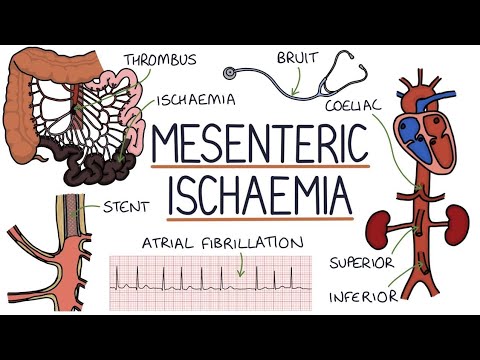 Mesenteric ischemia | Drk