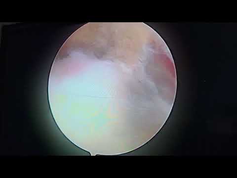 What shoulder looks like in a subacromial decompression