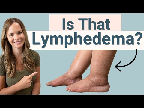 Lymphedema Signs and Symptoms video modal