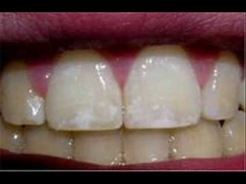 How to Identify Dental Fluorosis