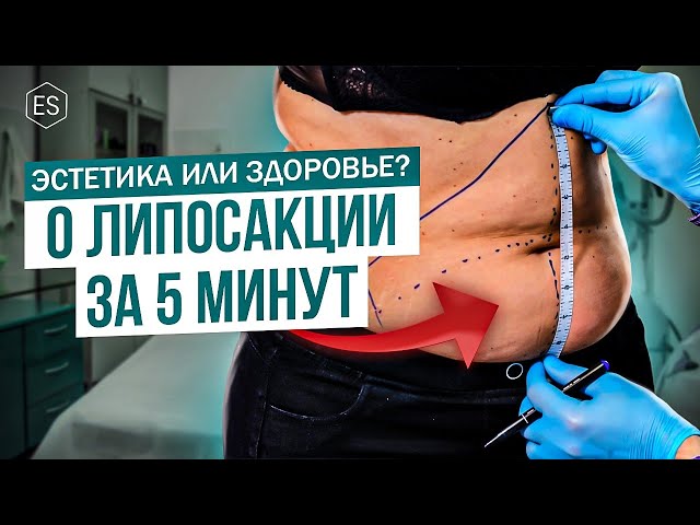 О ЛИПОСАКЦИИ за 5 минут. Эстетика или здоровье? Мнение пластического хирурга. — Елена Сухопарова.
