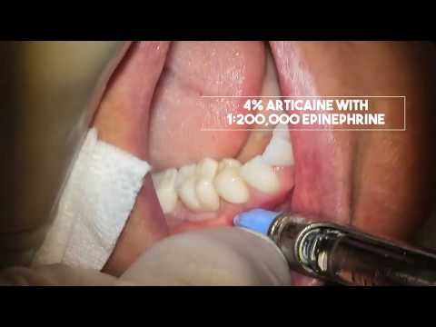 Stabident Intraosseous Anesthesia Technique - Dr. Berlin