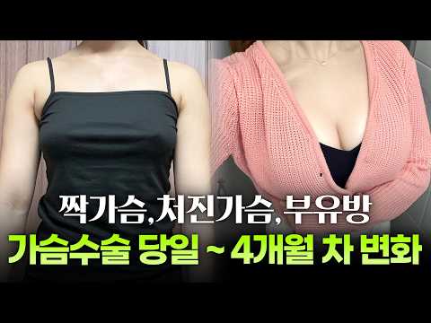 짝가슴 개선을 위해 뼈 구조까지 고려하는 리프팅가슴성형, 리얼 성형 브이로그 후기ㅣ디에이성형외과ㅣ맞춤형리프팅가슴성형