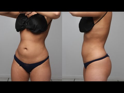Lipo or Tummy Tuck? How to tell which one is right for you