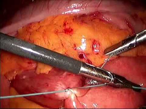 Laparoscopic Duodenojejunostomy For SMA Syndrome 