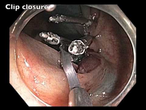 Zastawka krętniczo-kątnicza: płaska zmiana - endoskopowa resekcja śluzówki