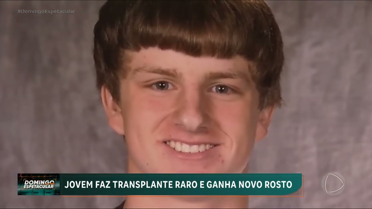 Jovem americano faz transplante raro e ganha um novo rosto | Domingo Espetacular