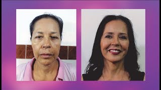 LIFTING FACIAL 👸 REJUVENECIMIENTO FACIAL ANTES y DESPUES 💕CIRUGÍA PLASTICA NEVADO 💜 Dr. Percy Nevado