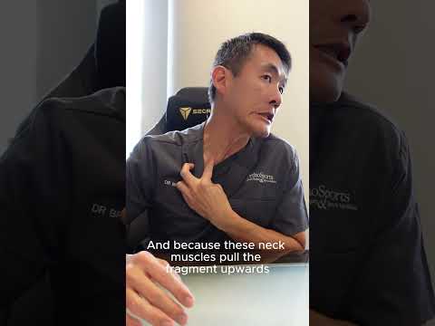 Clavicle Fracture Explained: Causes, Symptoms & Treatment  | PART 1