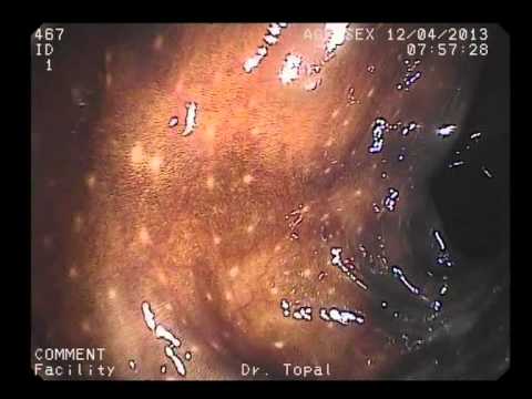 a bőr giardiasis tünetei