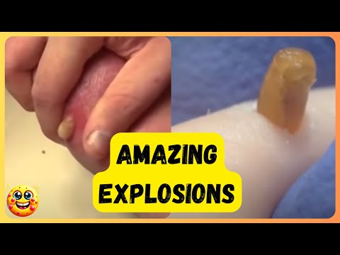 ???????? Epic Pimple Popping Compilation: Flying Zits & Massive Cyst Explosions! ????????