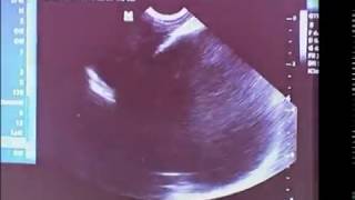 Amazing Hysteroscopy by Shawki : Shawki Vaginoplasty for  OHVIRA syndrome