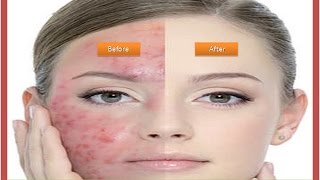 How To Get Rid of Redness on Face - 7 Most Effective Natural Ways