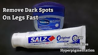 How To Remove Dark Spots On Legs Scar Mosquito Bites, Hyperpigmentation With Toothpaste On Legs Fast