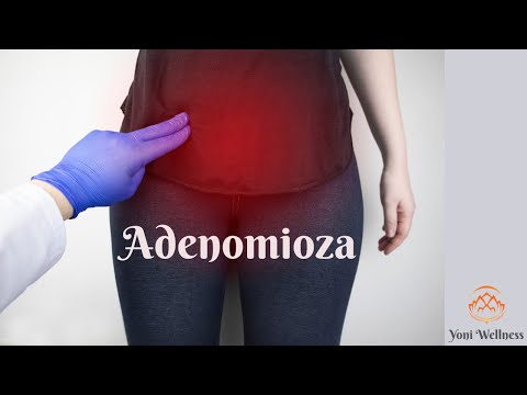 S2. Ep 50 - Adenomioza | Ce are în comun cu endometrioza | Simptome | Cum se tratează?