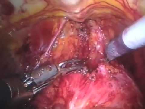 Prostate Excision Using Robotic-Assisted Method