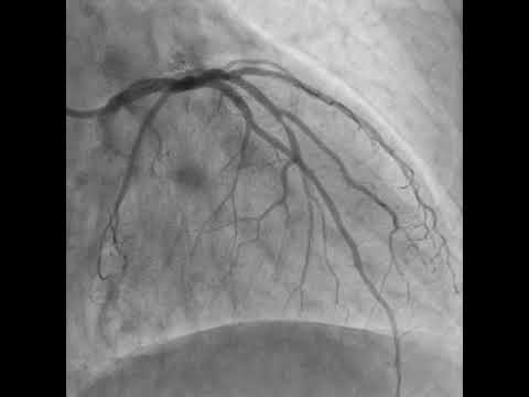CRUSH TECHNIQUE STENTING OF LAD - D1 BIFURCATION
