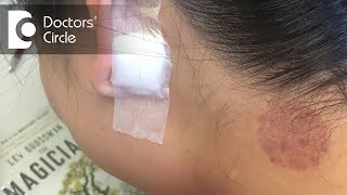 What causes itching & swollen lymph nodes near both the ear lobes? - Dr. Satish Babu K
