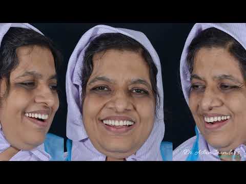 Full Mouth Rehabilitation