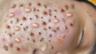 Loan Nguyen Acne Treatment 4m