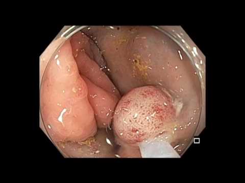 Colonoscopy: Cecal Flat Lesion EMR