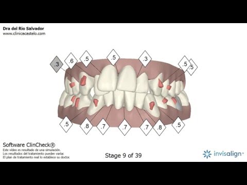 Clincheck Invisalign – Vídeo en 3D